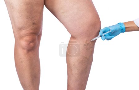 Photo for Removal of varicose veins on the legs. Medical inspection and treatment of Telangiectasia. Phlebeurysm. - Royalty Free Image