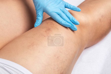 Photo for Removal of varicose veins on the legs. Medical inspection and treatment of Telangiectasia. Phlebeurysm. - Royalty Free Image