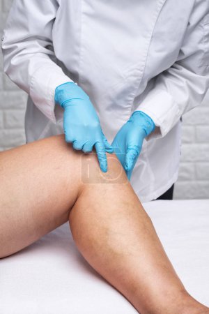 Enlèvement des varices sur les jambes. Inspection médicale et traitement de la télangiectasie. Phlébeurisme.