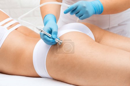 Photo for A beautician makes a microdermabrasion procedure to remove stretch marks on the thighs of a young woman. - Royalty Free Image