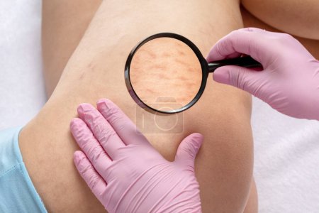 Téléchargez les photos : Le médecin examine les cuisses d'une femme qui a des vergetures sur la peau. Traitement des vergetures cutanées à la clinique. - en image libre de droit