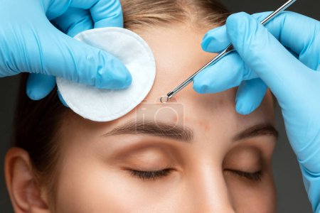 Ein Verfahren zur Reinigung der Gesichtshaut von Mitessern und Akne. Kosmetikerin behandelt problematische Gesichtshaut einer jungen Frau in Schönheitssalon. Ästhetische Kosmetologie und Make-up-Konzept.