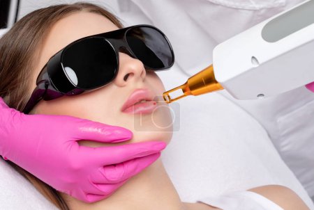 Démaquillage permanent sur les lèvres d'une femme.Peeling visage carbone dans un salon de beauté. Matériel traitement de cosmétologie.