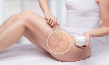 Une femme applique une pommade pour traiter la dilatation des petits vaisseaux cutanés sur ses jambes. Examen médical et traitement de la télangiectasie. Phlébeurisme.