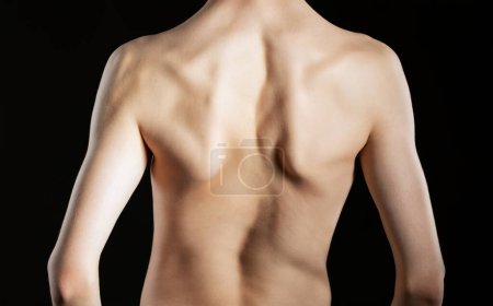 Foto de Un joven con una curvatura severa de la columna vertebral sobre un fondo negro. Tratamiento de escoliosis. - Imagen libre de derechos