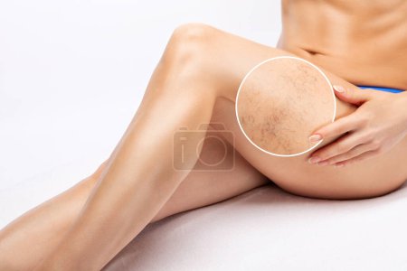 Una mujer muestra una malla capilar en sus piernas. Tratamiento de la expansión de pequeños vasos en las piernas. Examen médico y tratamiento de telangiectasias. Fleberismo.