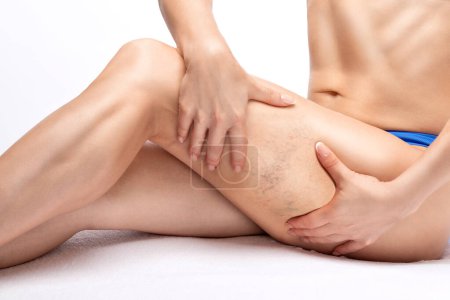 Foto de Una mujer muestra una malla capilar en sus piernas. Tratamiento de la expansión de pequeños vasos en las piernas. Examen médico y tratamiento de telangiectasias. Fleberismo. - Imagen libre de derechos