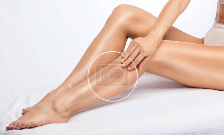 La femme montre la dilatation des petits vaisseaux sanguins de la peau sur la jambe. Inspection médicale et traitement de la télangiectasie. Phlébeurisme.