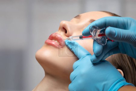 Injektionen zur Lippenvergrößerung Anti-Falten-Injektionen im Gesicht einer schönen Frau. Weibliche ästhetische Kosmetik in einem Schönheitssalon. Hämatome nach Lippenkonturierung.