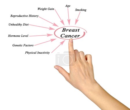Téléchargez les photos : Facteurs influençant le risque de cancer du sein - en image libre de droit
