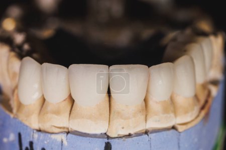 Photo for Close-up of an artificial metal free ceramic dental crown on a plaster model. The work of a dental technician. - Royalty Free Image