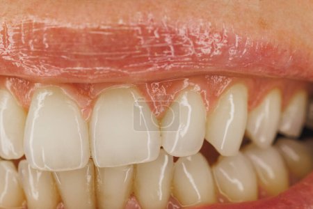 Foto de Inyección de una mujer irreconocible sonriendo brillantemente con los dientes antes de tener ortodoncista o trabajo dental hecho. - Imagen libre de derechos