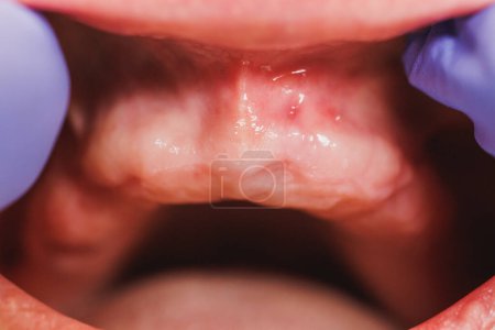Téléchargez les photos : Gros plan d'un patient méconnaissable avec des dents manquantes se préparant à l'implantation de dents dans une clinique dentaire. - en image libre de droit
