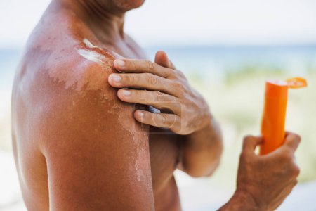 Foto de Close-up of a unrecognizable man applying suntan lotion to his sunburned shoulder. - Imagen libre de derechos