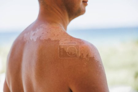 Téléchargez les photos : Close-up of a man's shoulder with sunburn. The skin sloughs off its his burn skin. It is the cause of melanoma. - en image libre de droit
