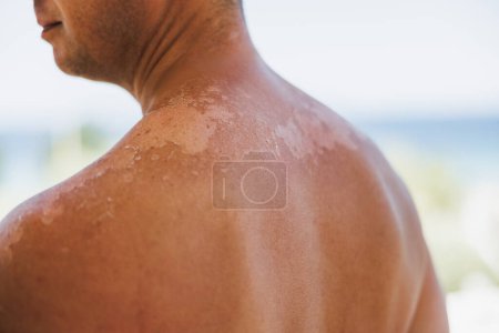 Téléchargez les photos : Gros plan de l'épaule d'un homme avec des coups de soleil. La peau se détache de sa peau brûlée. C'est la cause du mélanome. - en image libre de droit