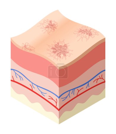 Illustration for Skincare medical concept. Problems in cross-section of human skin horizontal layers structure. Anatomy illustrative model unhealthly layer of skin. - Royalty Free Image