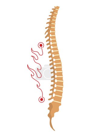 Illustration for Spinal deformity. Symbol of spine curvatures or unhealthy backbones. Human spine anatomy, curved spine. Diagram with marked section. Body posture defect. - Royalty Free Image