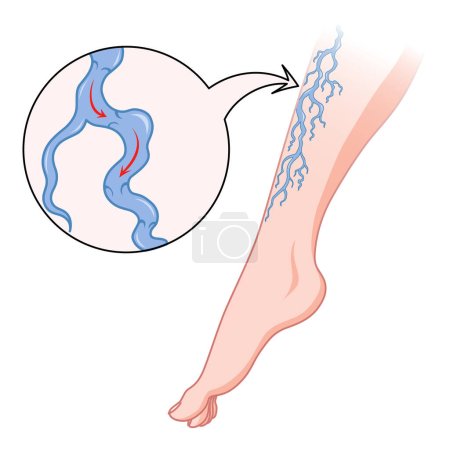 Illustration for Varicose veins. Blue blood vessel visible through the skin, abnormally swollen leg. Vascular disease diagnostic and treatment. Venous insufficiency medical flat. - Royalty Free Image