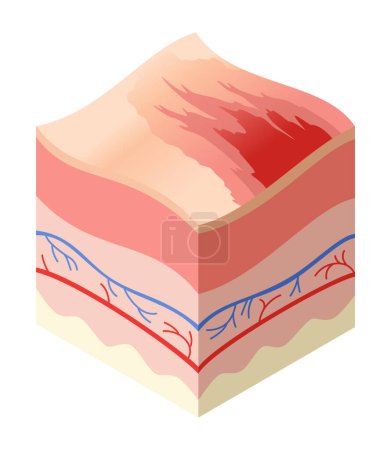 Illustration for Skincare medical concept. Problems in cross-section of human skin horizontal layers structure. Anatomy illustrative model unhealthly layer of skin. - Royalty Free Image