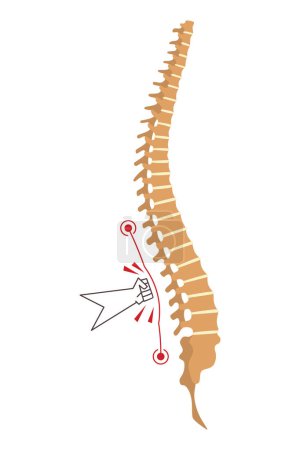 Illustration for Spinal deformity. Symbol of spine curvatures or unhealthy backbones. Human spine anatomy, curved spine. Diagram with marked section. Body posture defect. - Royalty Free Image