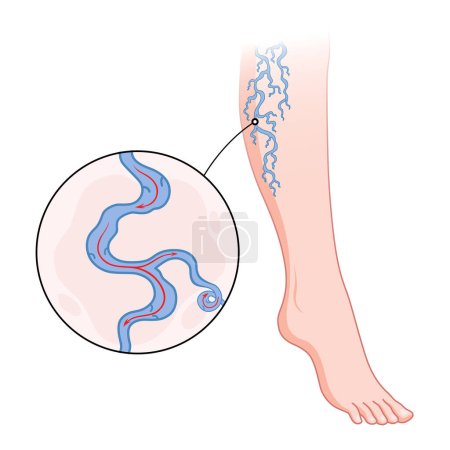 Varicose veins. Blue blood vessel visible through the skin, abnormally swollen leg. Vascular disease diagnostic and treatment. Venous insufficiency medical disease.