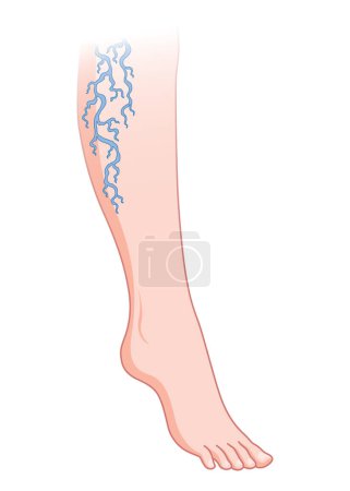 Illustration for Varicose veins. Blue blood vessel visible through the skin, abnormally swollen leg. Vascular disease diagnostic and treatment. Venous insufficiency medical disease. - Royalty Free Image