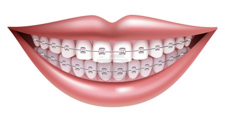 Téléchargez les illustrations : Orthèses Orthodontie correctrice, bouche féminine souriante avec des dents et des orthèses saines
. - en licence libre de droit
