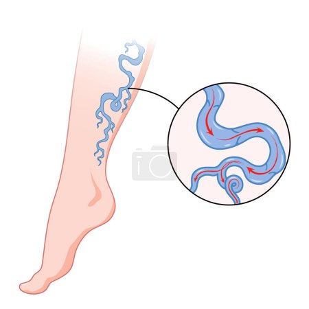 Illustration for Varicose veins. Blue blood vessel visible through the skin, abnormally swollen leg. Vascular disease diagnostic and treatment. Venous insufficiency medical disease. - Royalty Free Image