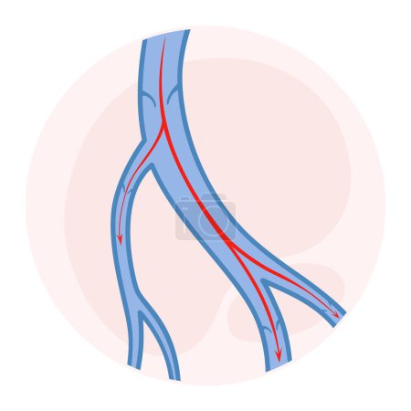 Illustration for Varicose veins. Blue blood vessel visible through the skin. Vascular disease diagnostic and treatment. Venous insufficiency medical. - Royalty Free Image