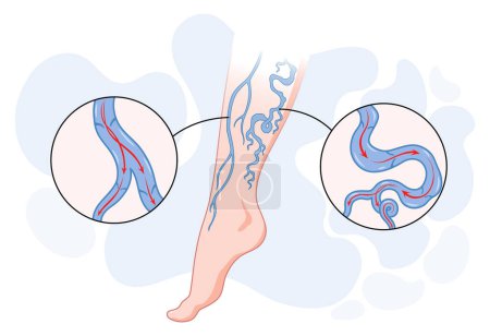 Venas varicosas. Vaso sanguíneo azul visible a través de la piel, pierna anormalmente hinchada. Diagnóstico y tratamiento de la enfermedad vascular. Insuficiencia venosa enfermedad médica.