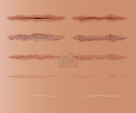 Illustration for Set of healing wounds, skin scars, stitched gash and cuts. Realistic surgical sutures, stitched wounds at different healing stages isolated on human skin background. - Royalty Free Image