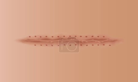 Healing wounds, skin scar, stitched gash and cut. Realistic surgical suture, stitched wounds. Healing stage on human skin background. Vector illustration.