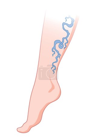 Krampfadern. Blaue Blutgefäße, die durch die Haut sichtbar sind, abnormal geschwollenes Bein. Diagnose und Behandlung von Gefäßerkrankungen. Venöse Mangelkrankheit.