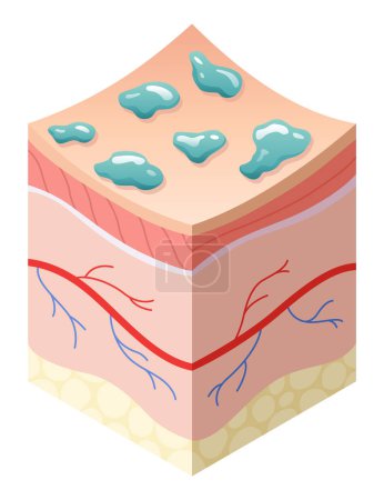 Skincare medical concept. Problems in cross-section of human skin horizontal layers structure. Anatomy illustrative model unhealthy layer of skin.