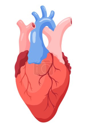 Ilustración de Etapa de aterosclerosis. Anatomía del ataque cardíaco. Enfermedad vascular arteriosclerótica o ASVD. Ilustración vectorial sobre fondo blanco. - Imagen libre de derechos