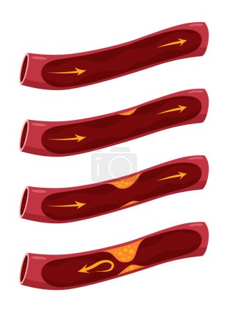 Illustration for Atherosclerosis stage. Anatomy of heart attack. Arteriosclerotic vascular disease or ASVD. Atherosclerotic plaque in coronary artery. Vector illustration on white background. - Royalty Free Image