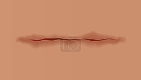 Illustration for Healing wounds, skin scar, stitched gash and cut. Realistic surgical suture, stitched wounds. Healing stage on human skin background. Vector illustration. - Royalty Free Image