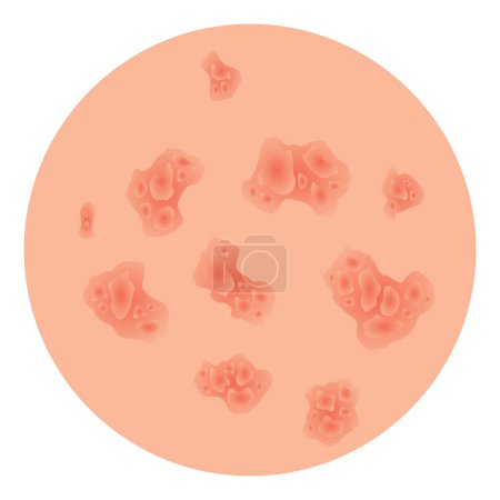 Type of psoriasis vector. Part of patients skin with dermatitis, inflammation, red rash and other skin problems. Cartoon illustration for disease concept.