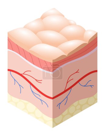 Concept médical de soins de la peau. Problèmes dans la section transversale de la structure des couches horizontales de la peau humaine. Anatomie modèle illustratif couche malsaine de la peau.