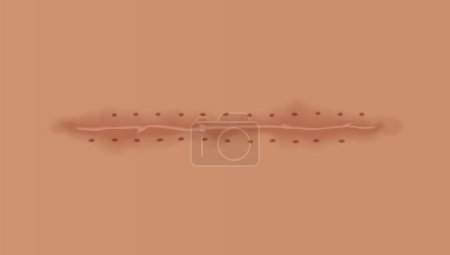 Healing wounds, skin scar, stitched gash and cut. Realistic surgical suture, stitched wounds. Healing stage on human skin background. Vector illustration.