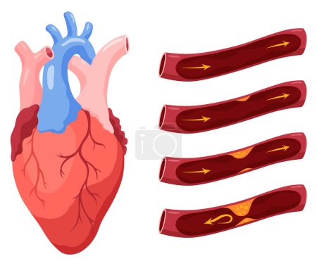 Atherosclerosis stages. Anatomy of heart attack. Arteriosclerotic vascular disease or ASVD. Atherosclerotic plaque in coronary artery. Vector illustration on white background.