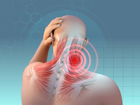 Téléchargez les photos : Douleurs musculaires dans la région du cou et des épaules. Illustration numérique, rendu 3D. - en image libre de droit