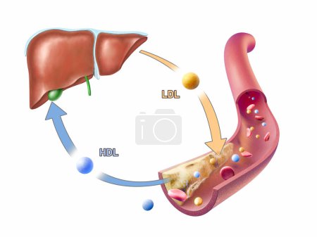 High density and low density lipoproteins adding and removing cholesterol from an arterial plaque. Digital illustration, 3D render.