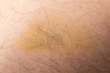 Wound spot on human skin yellow color close up view