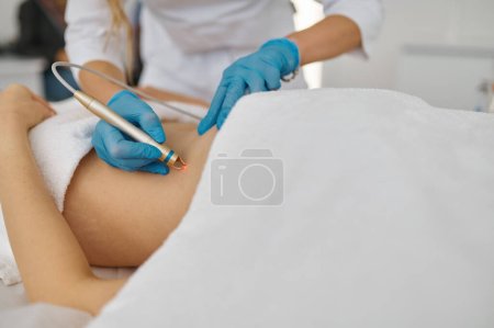 Téléchargez les photos : Électro-épilation procédure de cosmétologie pour l'épilation de l'abdomen de la femme - en image libre de droit
