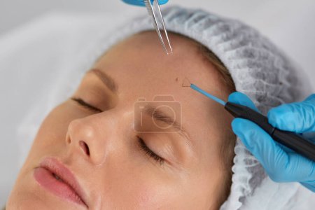Entfernung des Muttermal von der Client-Stirn Nahaufnahme. Mikrochirurgie und kosmetologisches Konzept