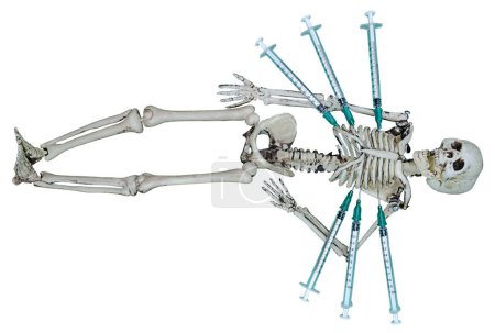 Skeleton laying out with syringes stuck in him
