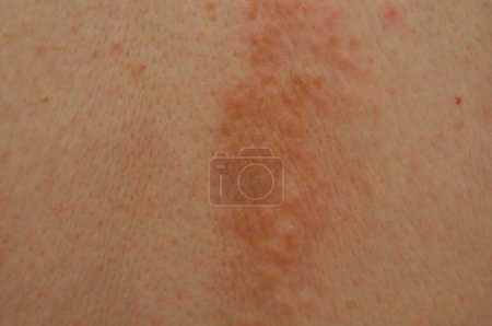 Foto de Eczema espinillas en la espalda - Imagen libre de derechos