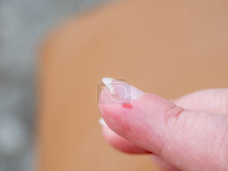 Herida de abrasión en el dedo índice